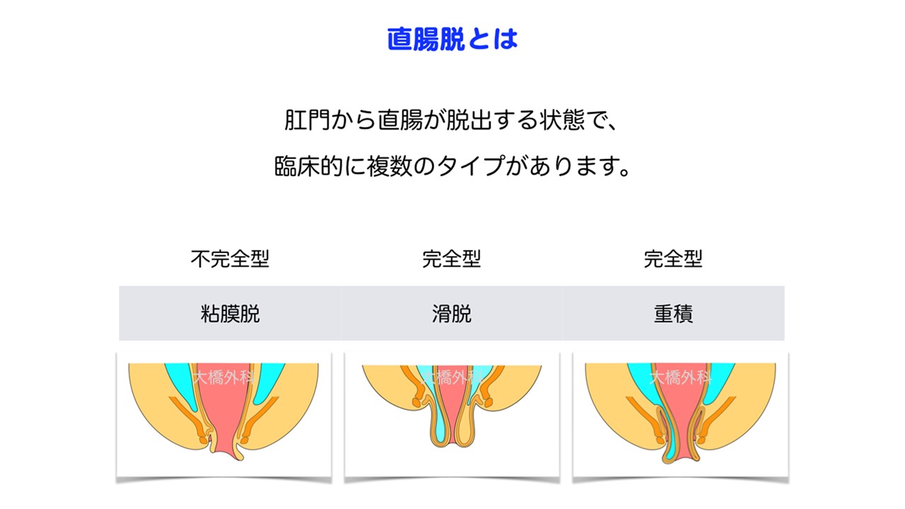 骨盤臓器脱 診療案内 大橋胃腸肛門科外科医院 07 41 8101 愛媛県新居浜市船木