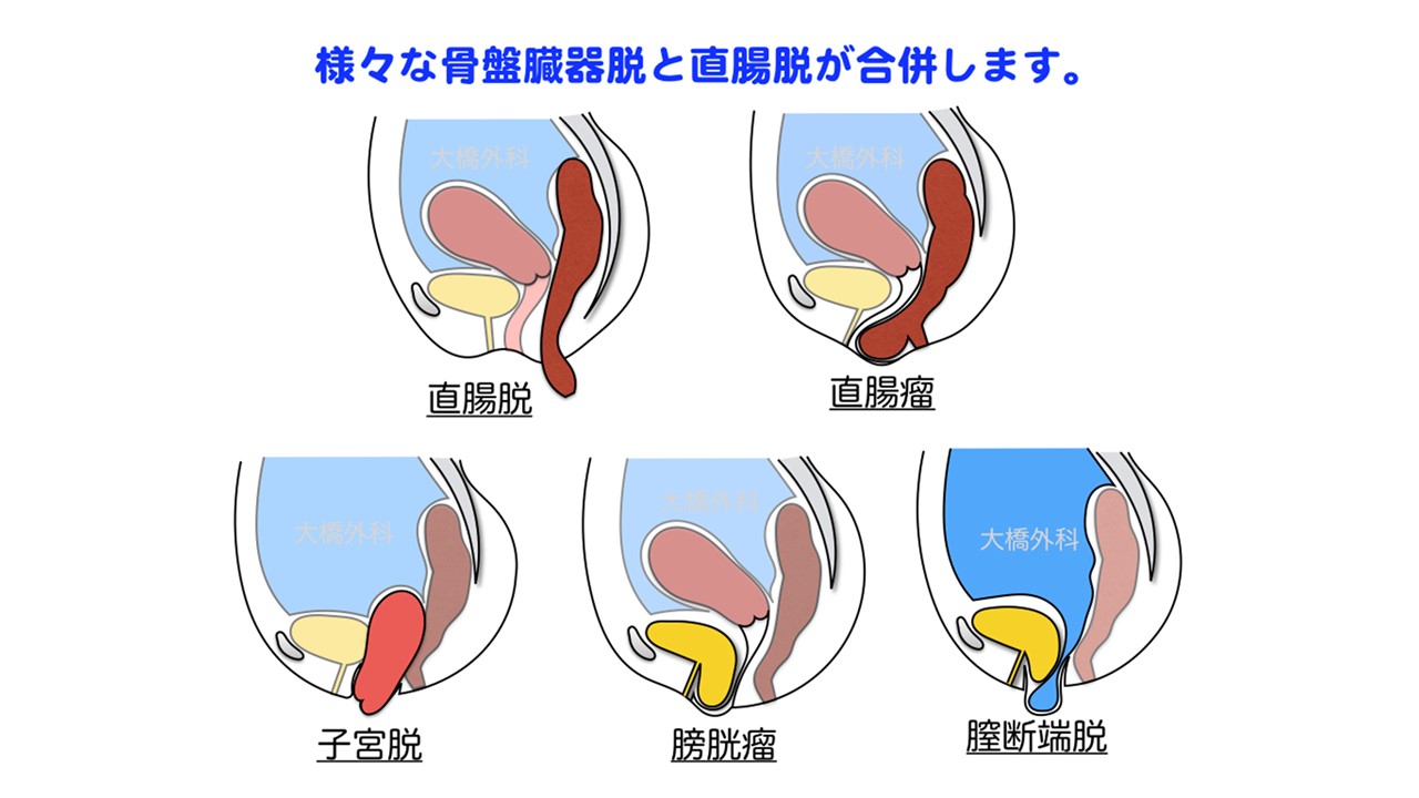 骨盤臓器脱  診療案内  大橋胃腸肛門科外科医院｜0897-41-8101｜愛媛 